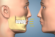 Class I Malocclusion Dental Skeletal
